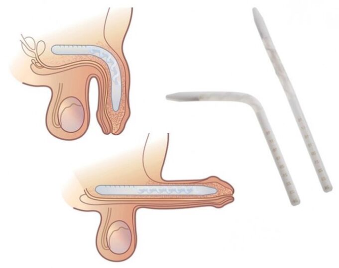 Falloplasty to increase a member