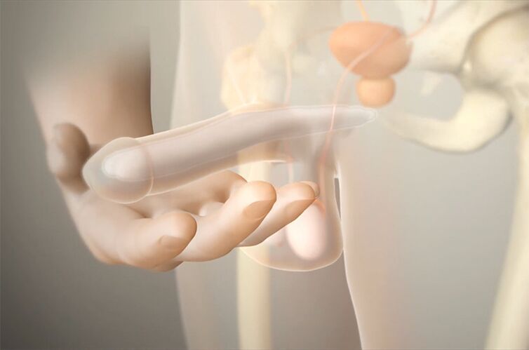 Gelimplants to increase a member