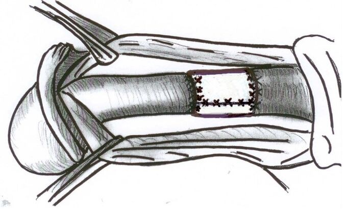 Installing a collagen matrix to increase a member