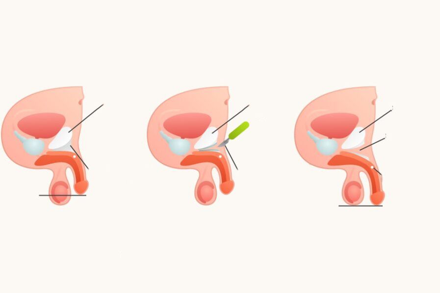 Ligamentotomy to increase penis