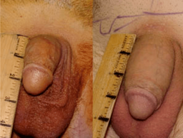 Before and after lipofilling and gel implantation
