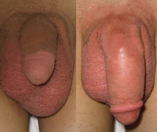 The result of installing a collagen matrix in the penis
