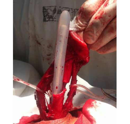 Muscle tissue transplantation to enlarge the penis